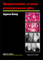 Ортодонтическое лечение ретенированных зубов