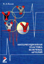 Интервенционная пластика венечных артерий