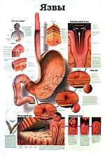 Язвы. Воспалительные нарушения тазобедренного и коленного суставов. Плакат