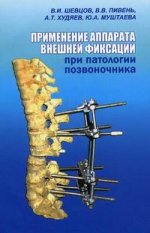 Применение аппарата внешней фиксации при патологии позвоночника